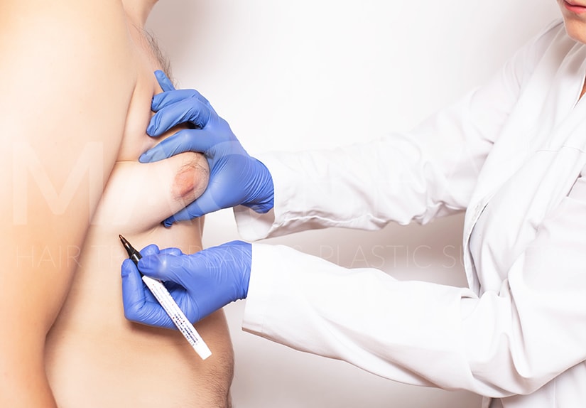 Gynecomastia: Breast Growth Problem in Men