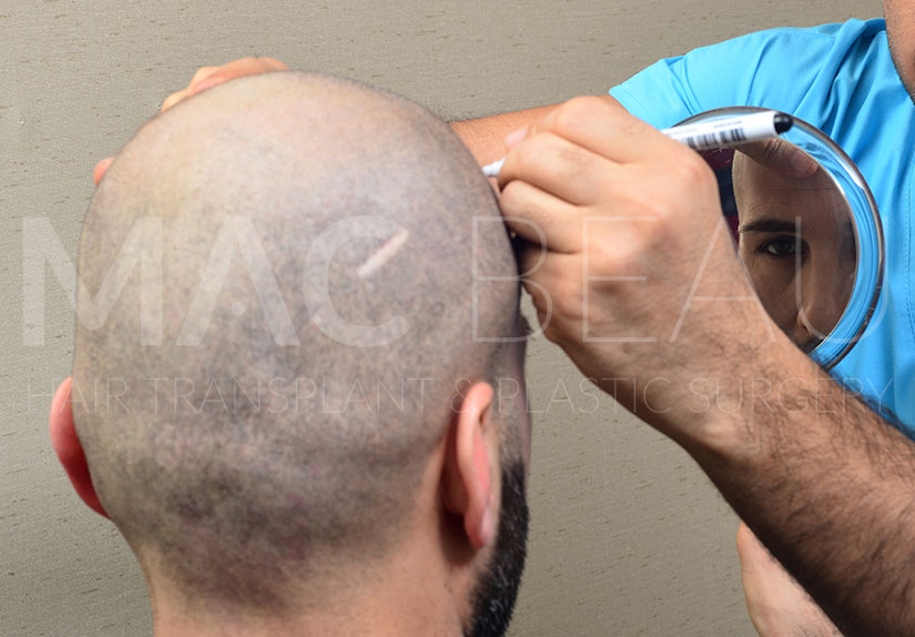 What is FUE Hair Transplantation?