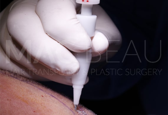 Dhi Without Shaving Hair Transplant