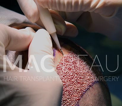 Needle-Free Anesthesia and Unshaved DHI Pen Technique Hair Transplantation