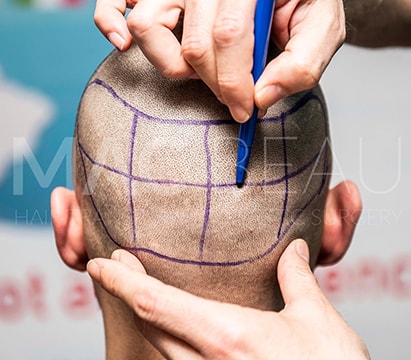 Needle-Free Anesthesia and Sapphire Supported Fue Hair Transplantation