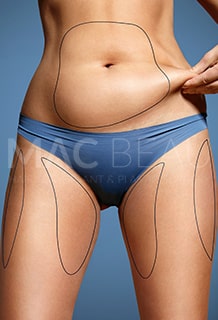Liposuction
