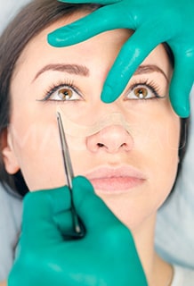 Rhinoplasty