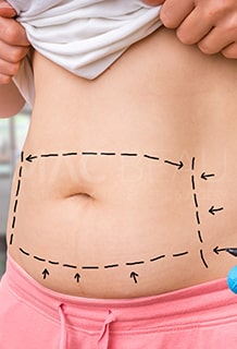 Tummy Tuck