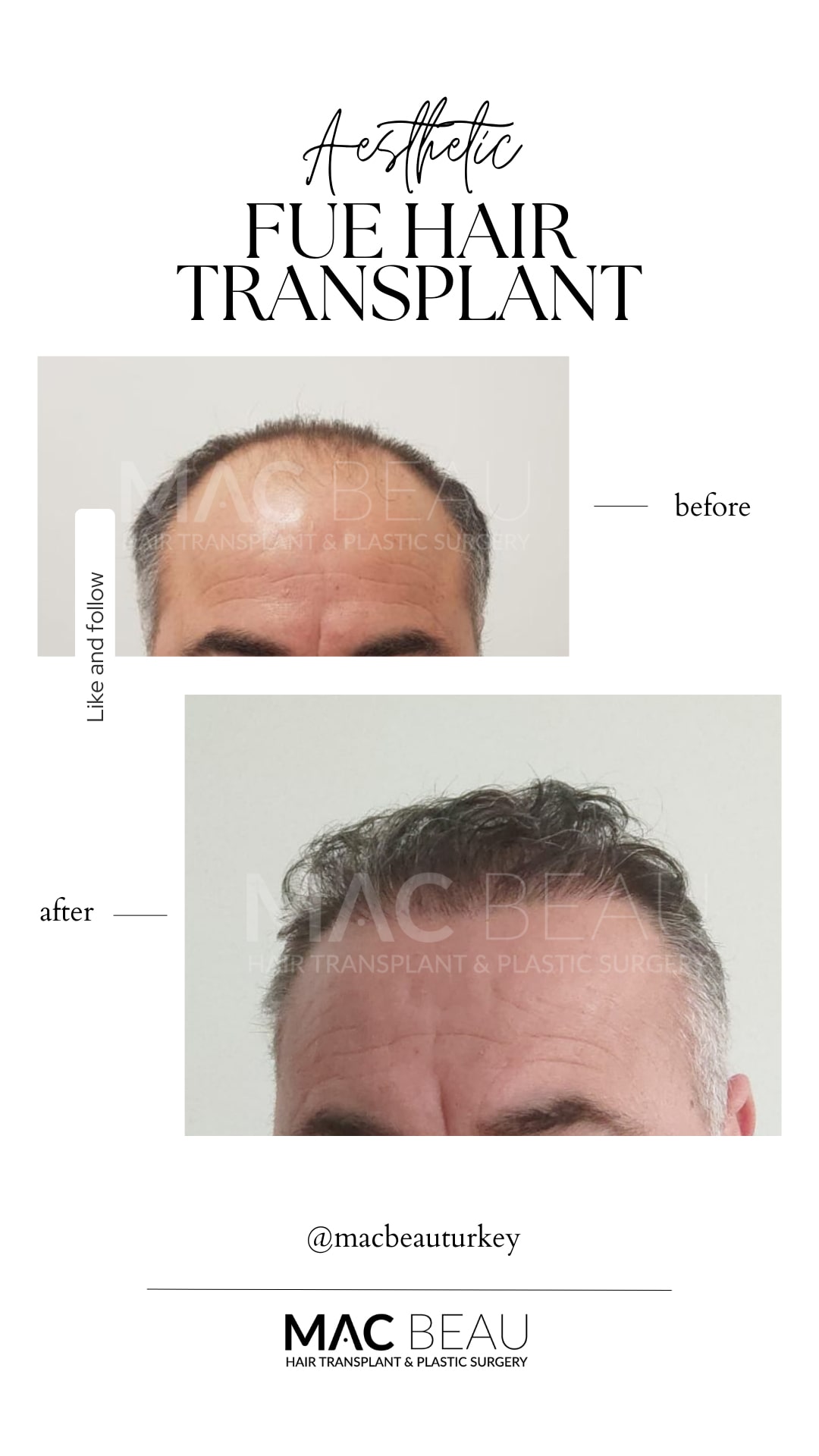 Fue Hair Transplantation Prices Turkey ⬅️ MAC BEAU®